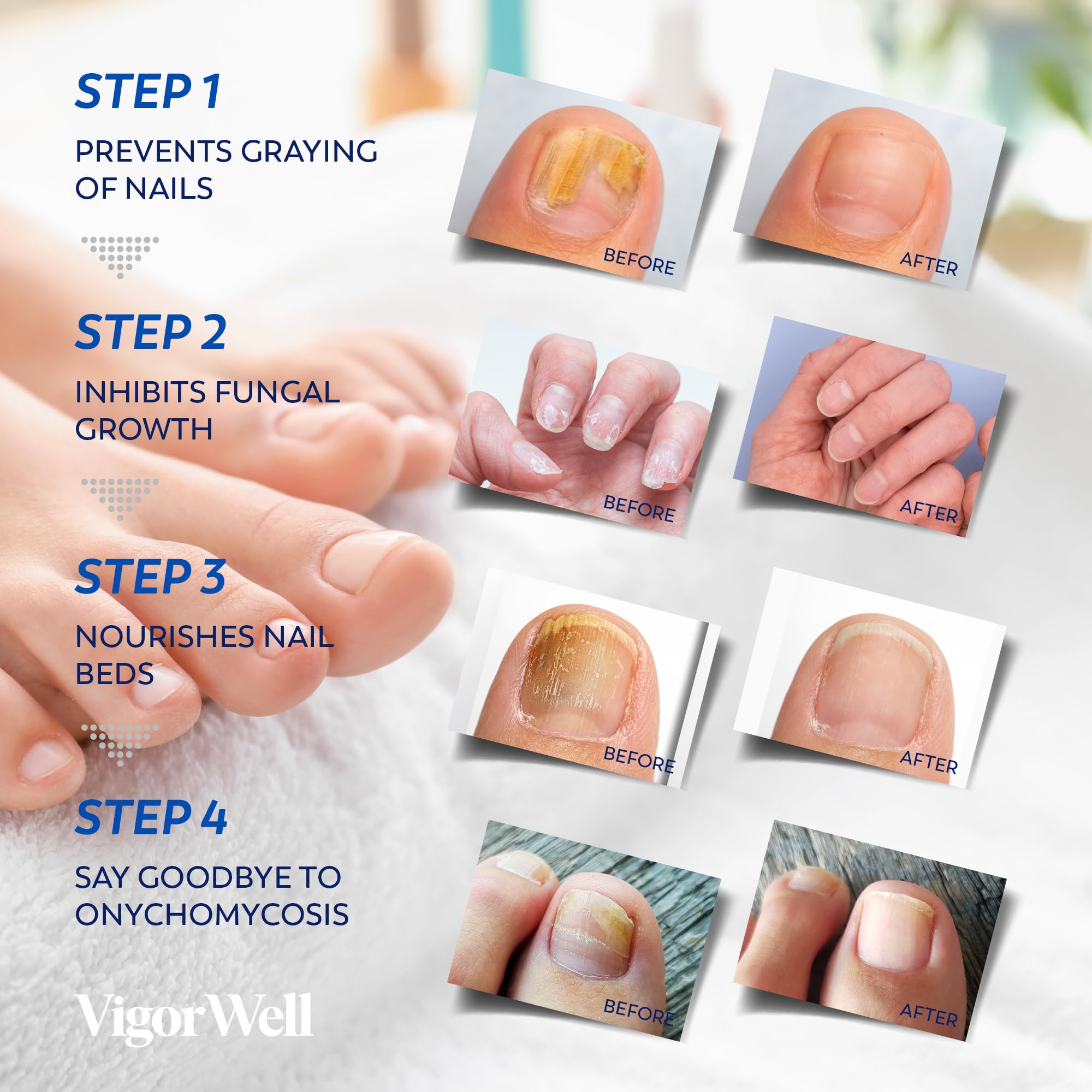 VigorWell Toenail Fungus Treatment Extra Strength - 32 Nighttime Hydrogel Patches for Overnight Nail Repair
