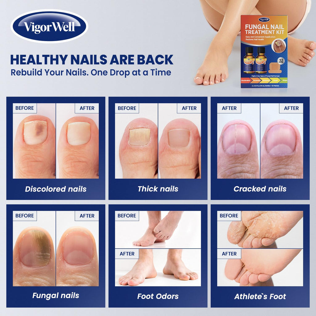 VigorWell Toenail Treatment Extra Strength – Dual Action Nail Repair Kit (30 ml Gel + 32 Patches)