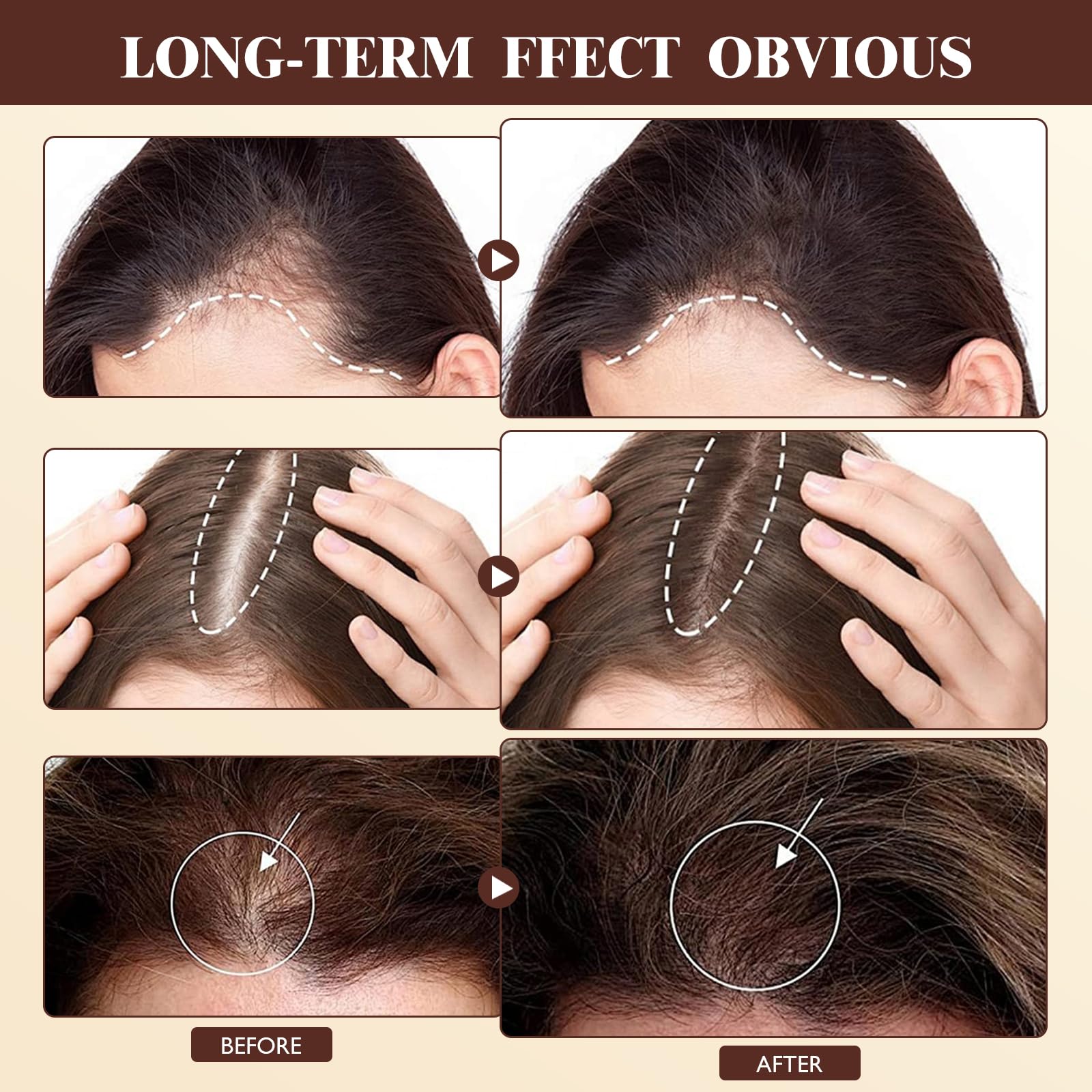 Vincofoo 2PC Hair Growth Spray – Natural Anti-Hair Loss for Thinning Hair