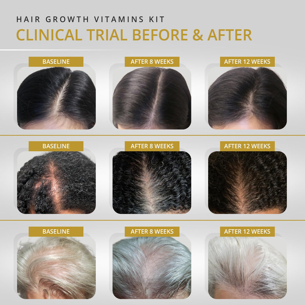 VITAMINS REVIVE Hair Supplement for Women – Clinically Tested Hair Growth Vitamins USA | Thinning & Thickening