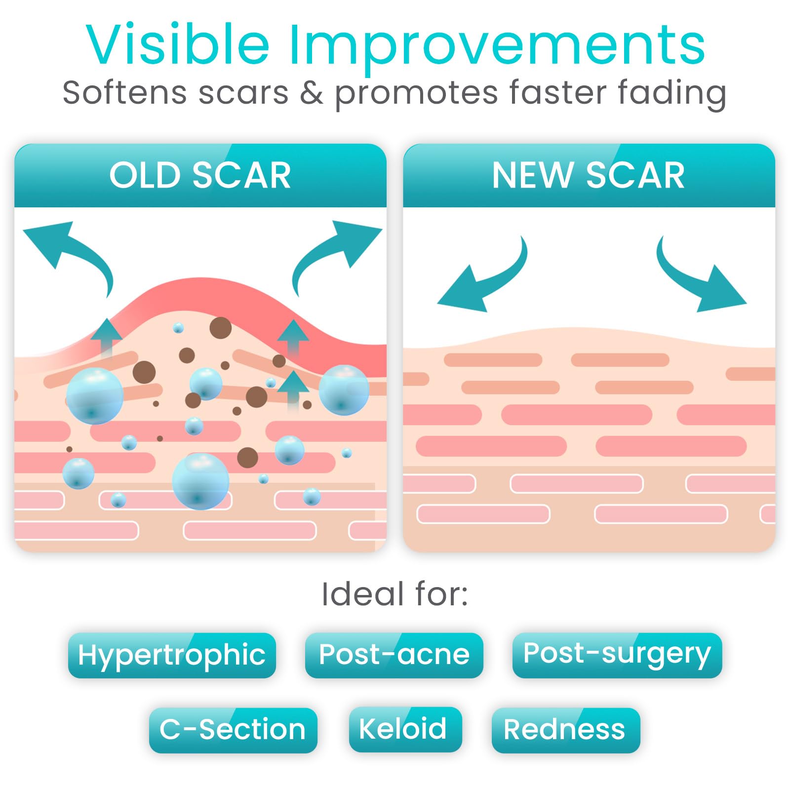 Vive Care Silicone Scar Sheets Tape – 1.6 inch x 120 inch Roll – Medical-Grade, Waterproof & Reusable