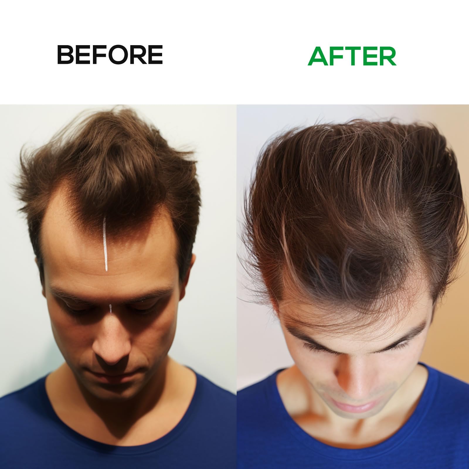 Winter Plum Laser Hair Growth Cap – LLLT Hair Growth Device (650nm, 5mW)