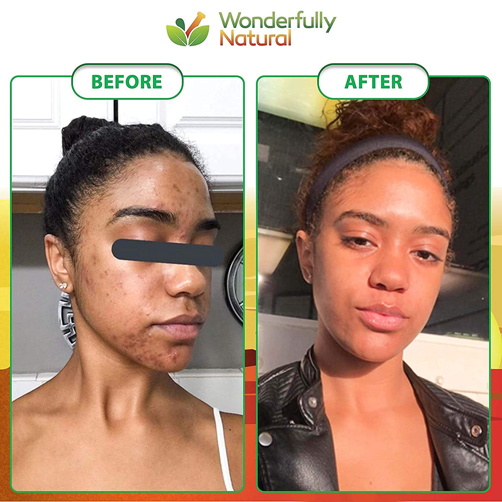 Wonderfully Natural African Black Soap Bar – Acne & Dark Spots, Vegan, 1lb (90 Day Supply)