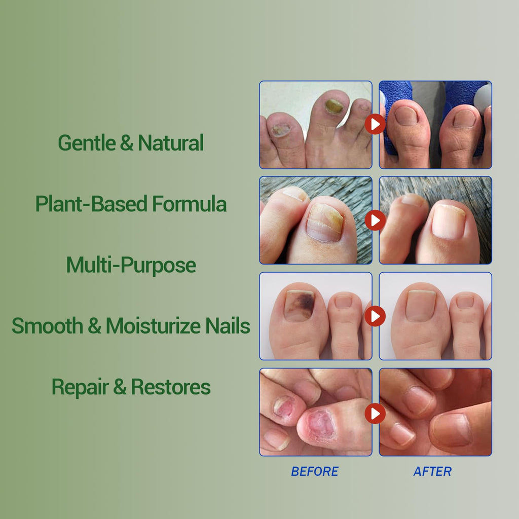 Xvywalo Nail Fungus Treatment Gel - Nail Growth Serum for Repair (2 pcs)