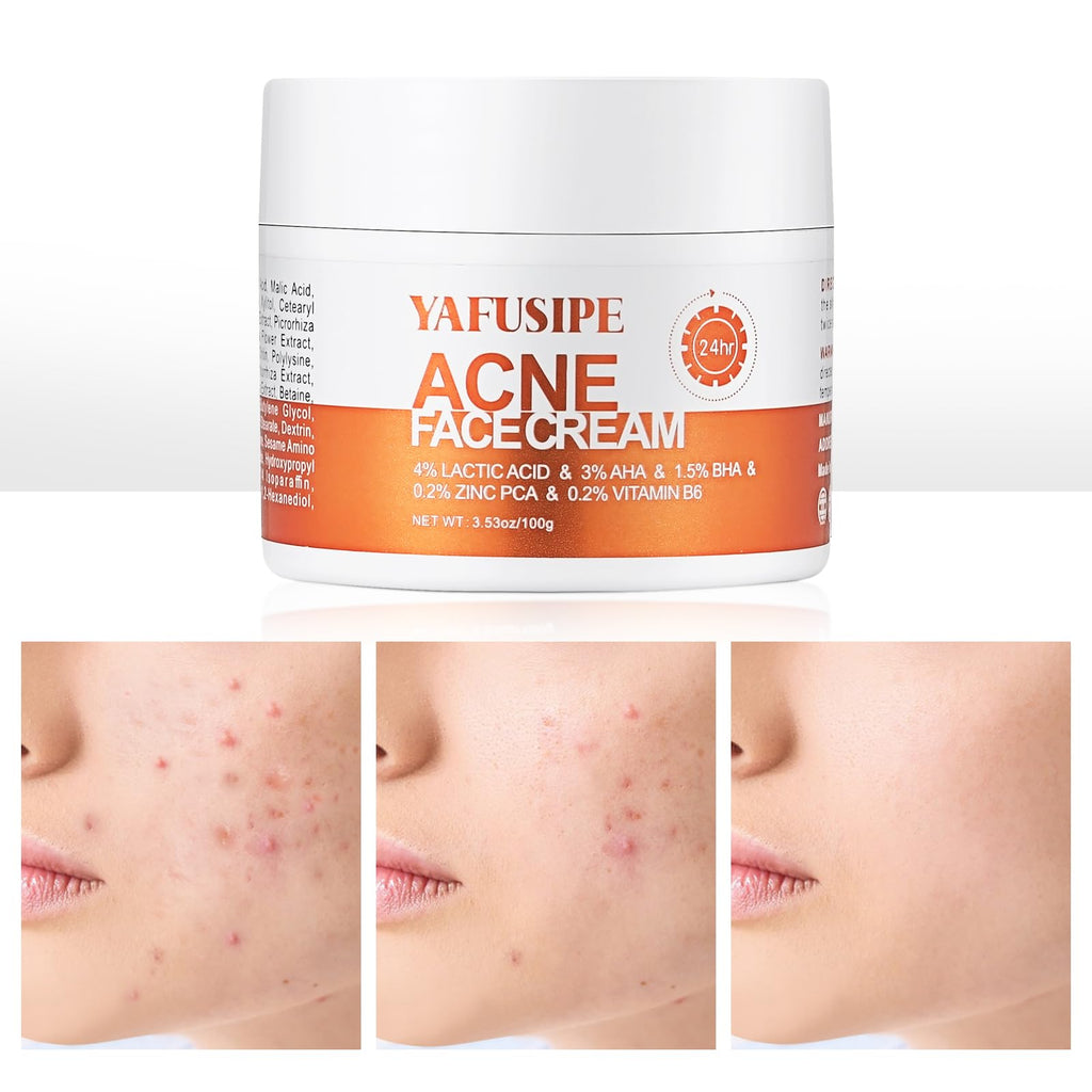 YAFUSIPE Acne Treatment Cream for Cystic Breakouts – Gentle, All-Skin-Types Formula
