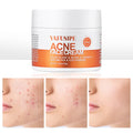 YAFUSIPE Acne Treatment Cream for Cystic Breakouts – Gentle, All-Skin-Types Formula