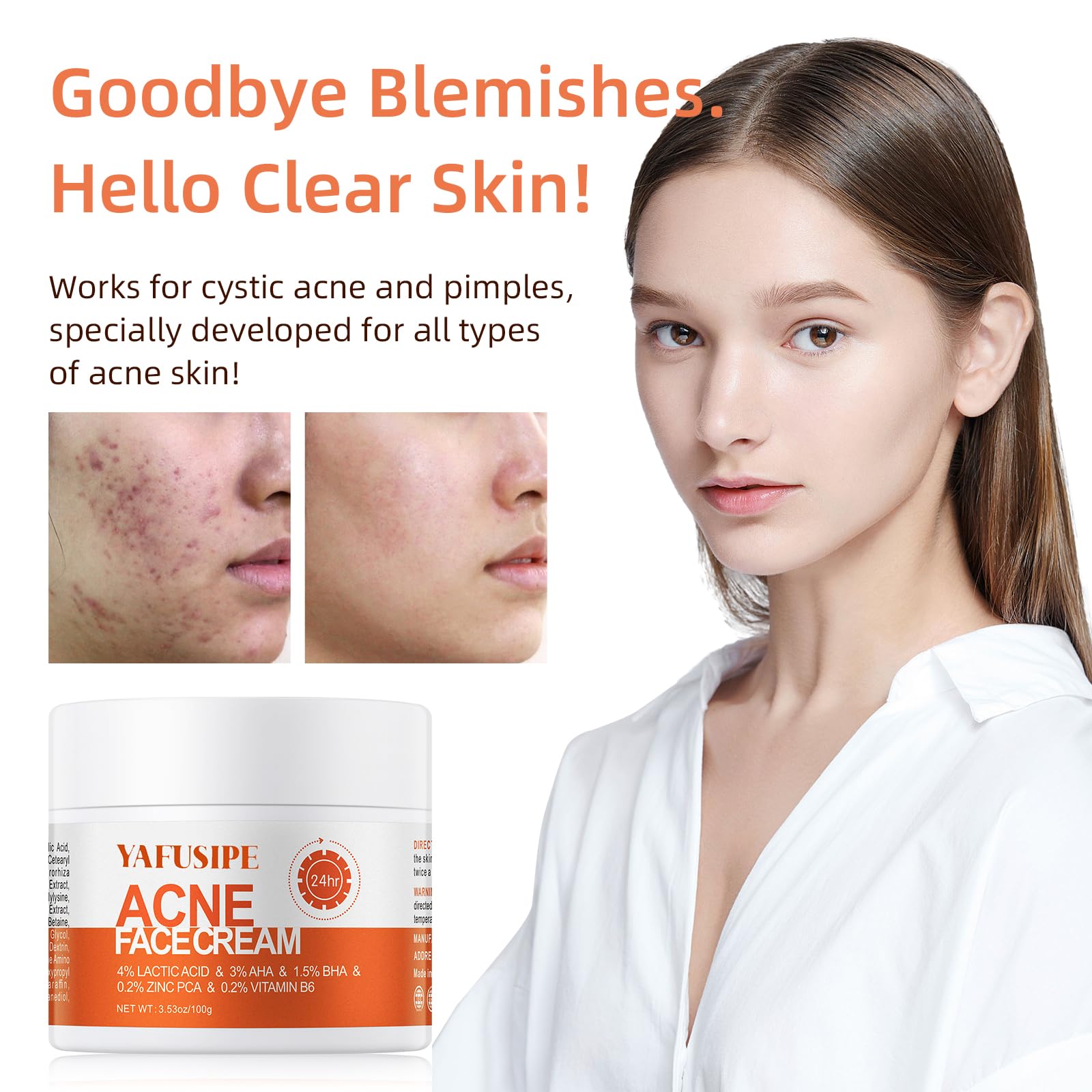 YAFUSIPE Acne Treatment Cream for Cystic Breakouts – Gentle, All-Skin-Types Formula