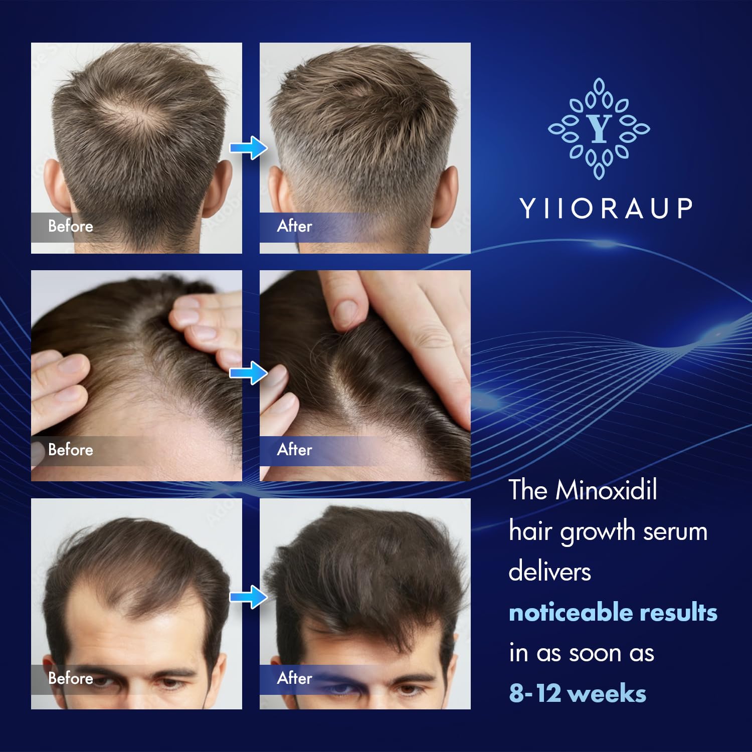 YIIORAUP 5% Minoxidil Hair Growth Solution – Extra Strength Topical for Men & Women (Biotin) – 2-Pack
