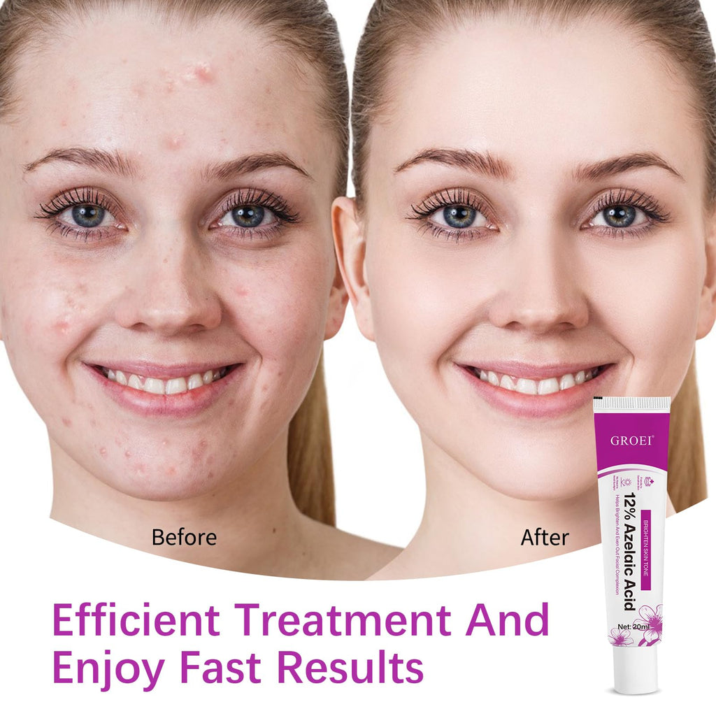 YILEST Azelaic Acid 12% Serum with Niacinamide & Hyaluronic Acid – 2PC