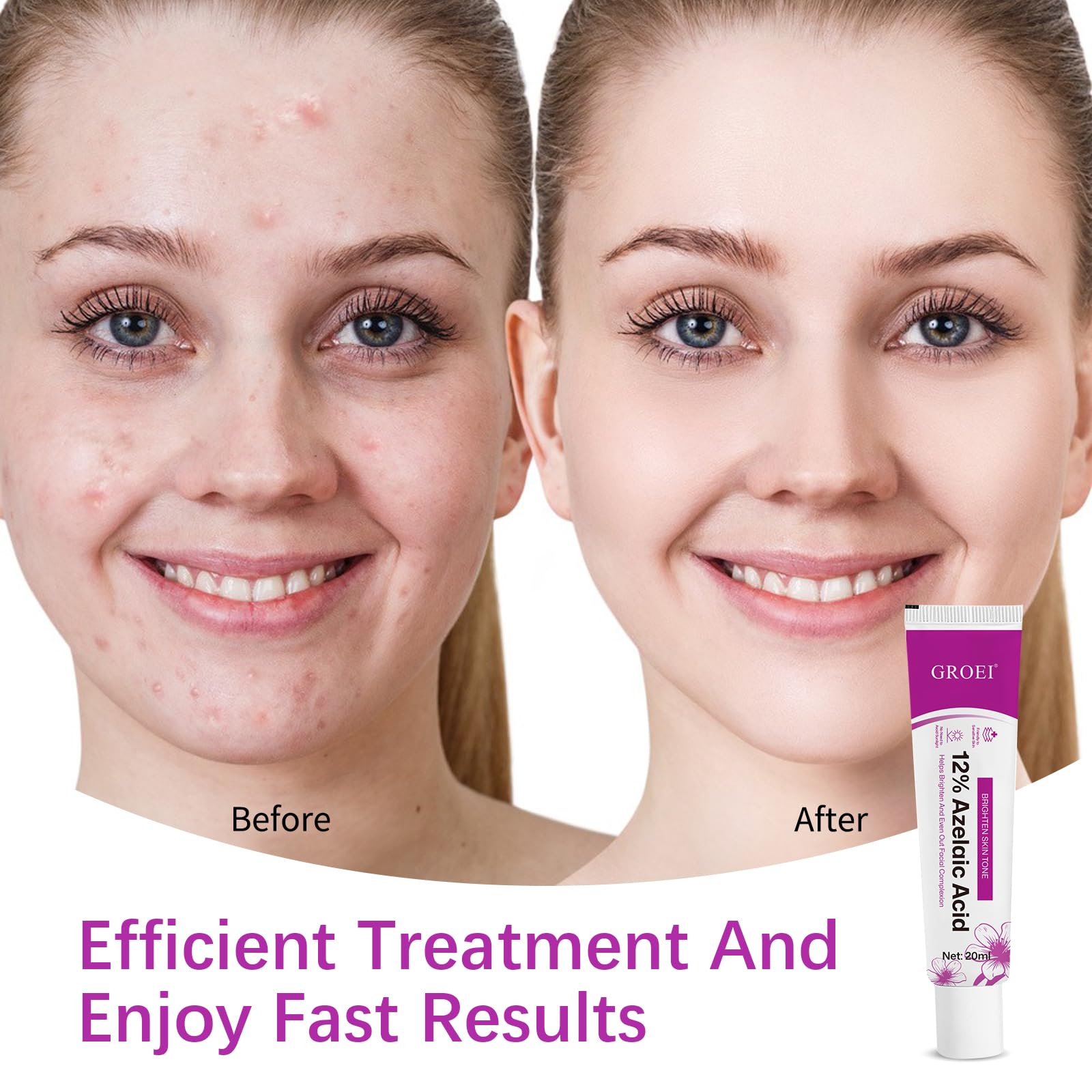 YILEST Azelaic Acid 12% Serum with Niacinamide & Hyaluronic Acid – 2PC
