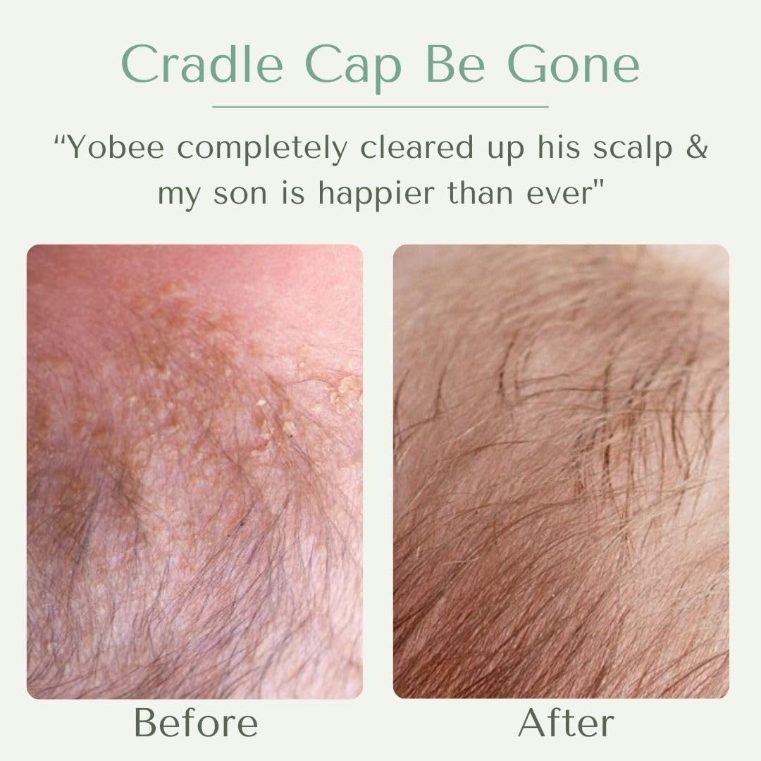 Yobee Ultra Gentle Scalp Mask – Probiotic Dry Scalp Care for Babies (4 oz)