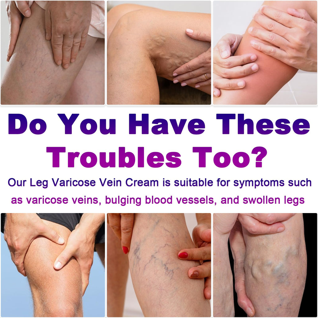 Yongsenina Varicose Veins Cream for Legs – Lightweight, Non-Sticky Vein & Spider Vein Treatment