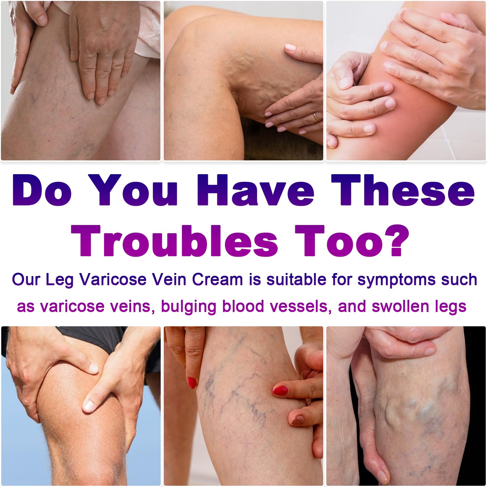 Yongsenina Varicose Veins Cream for Legs – Lightweight, Non-Sticky Vein & Spider Vein Treatment