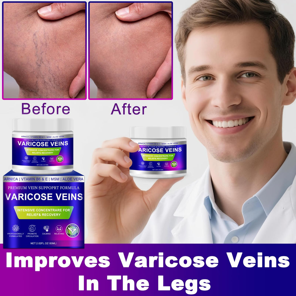 Yongsenina Varicose Veins Cream for Legs – Lightweight, Non-Sticky Vein & Spider Vein Treatment