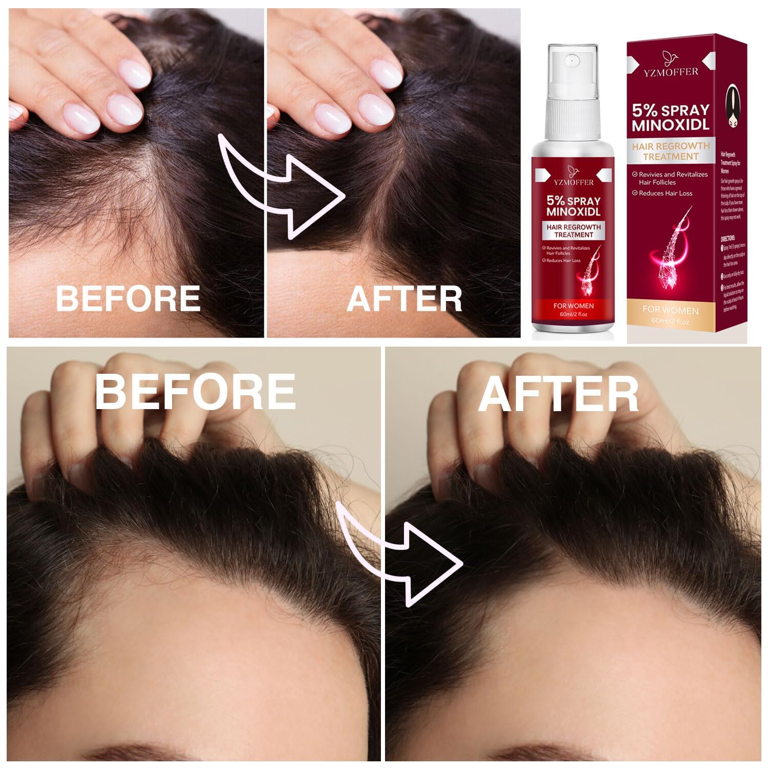 Yzmoffer 5% Minoxidil Spray for Women – Hair Regrowth 60ML x 2 Pack