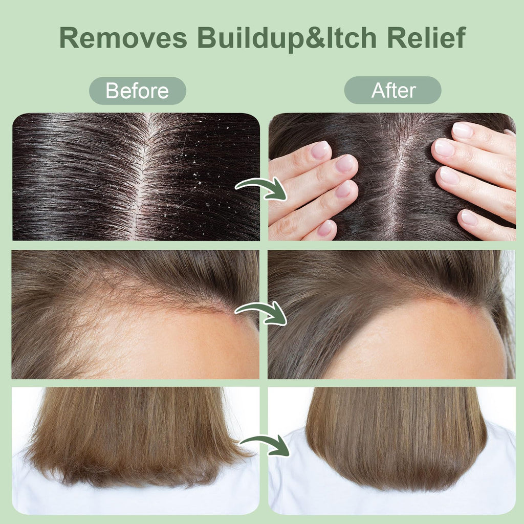ZENGYQI Scalp Scrub Rosemary & Mint with Biotin | Exfoliating Massager for Itchy Scalp