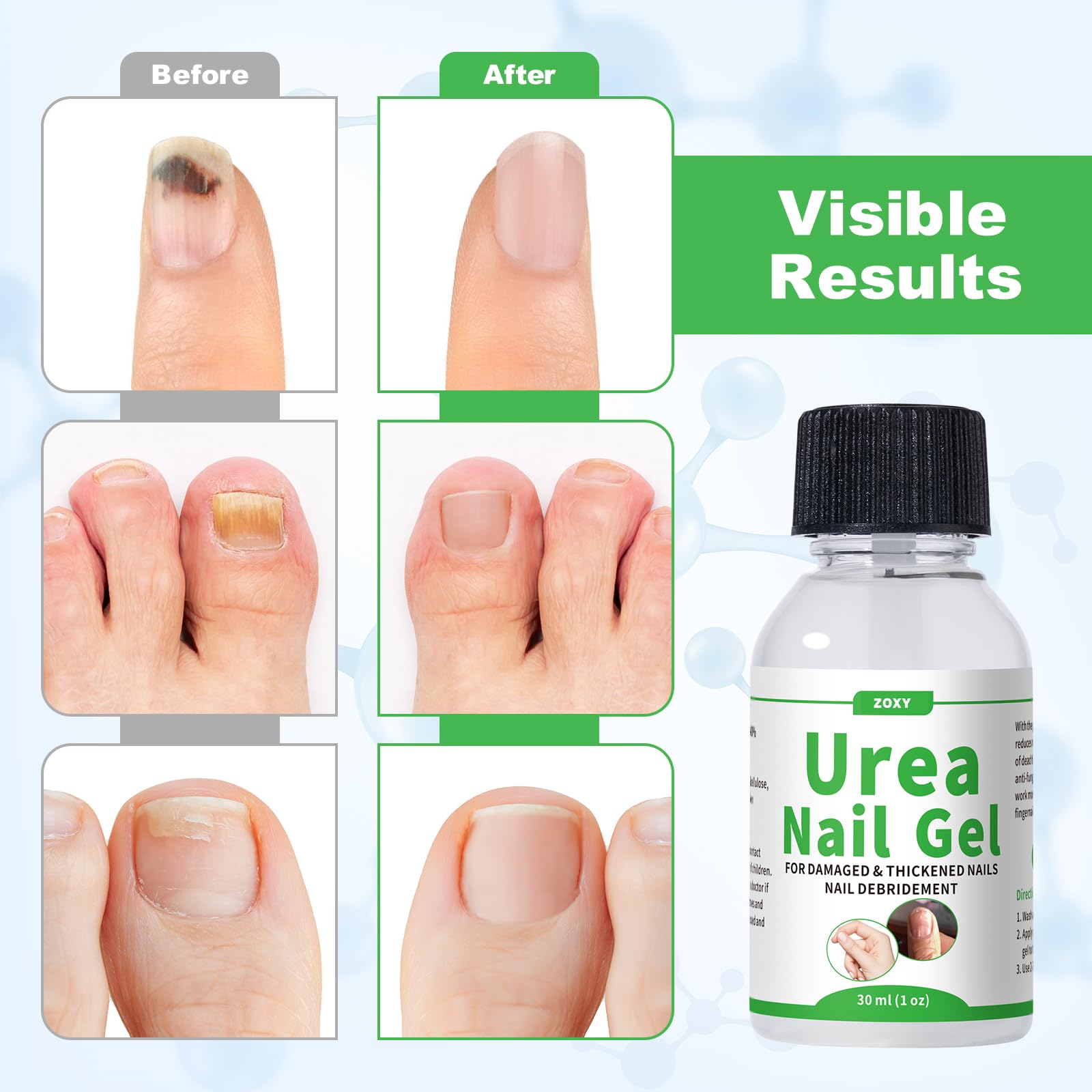ZOXY Urea Nail Gel 40% – Softens Thick Nails & Discoloration | Fast-Absorbing Nail Restoration